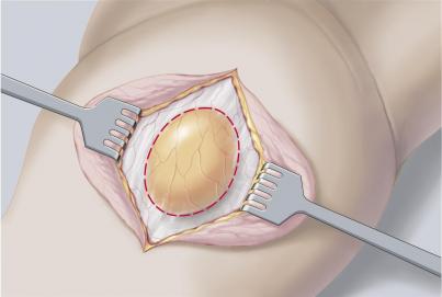 Laparoscopic Surgery with Meshplasty - TAPP/TEP, IPOM, IPOM Plus, TAPE etc