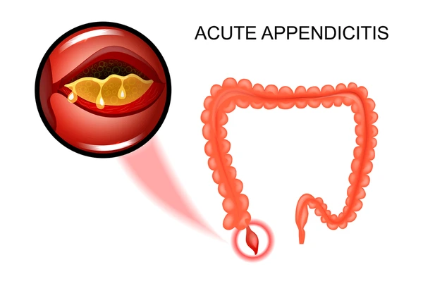 Acute Appendicitis