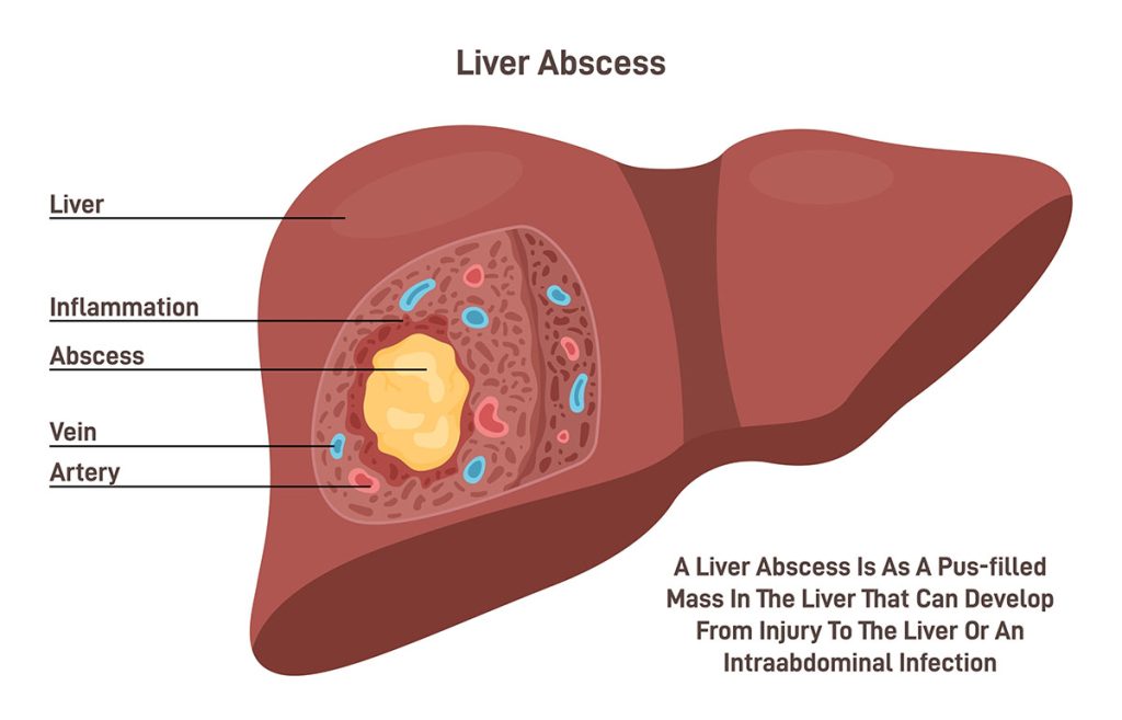 Amoebic Liver Abscess