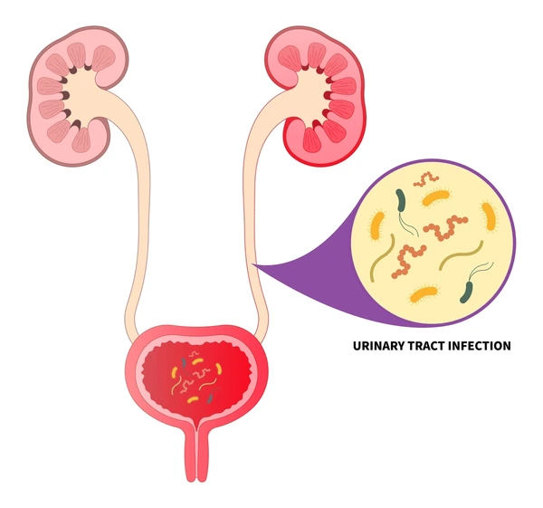 Urological conditions