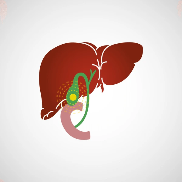 Acute Calculous Cholecystitis