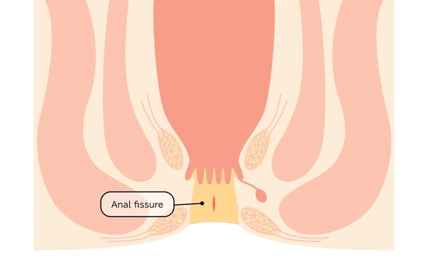 An Anal Fissure