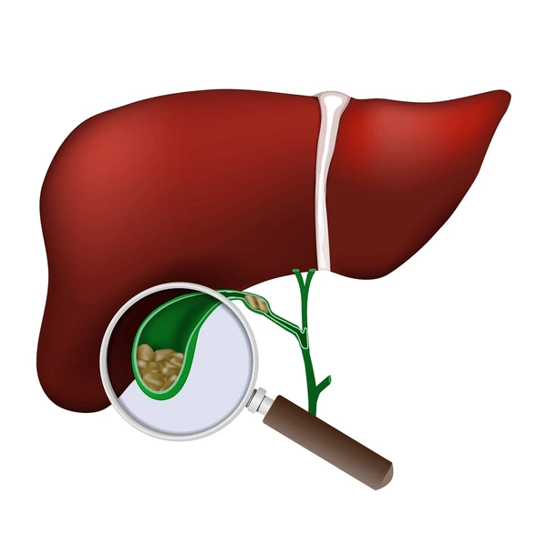 Gallstones