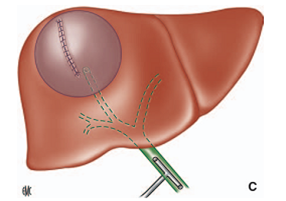 Hydatid Disease of the Liver