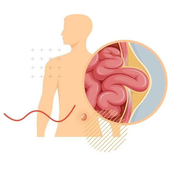 Strangulated Hernia