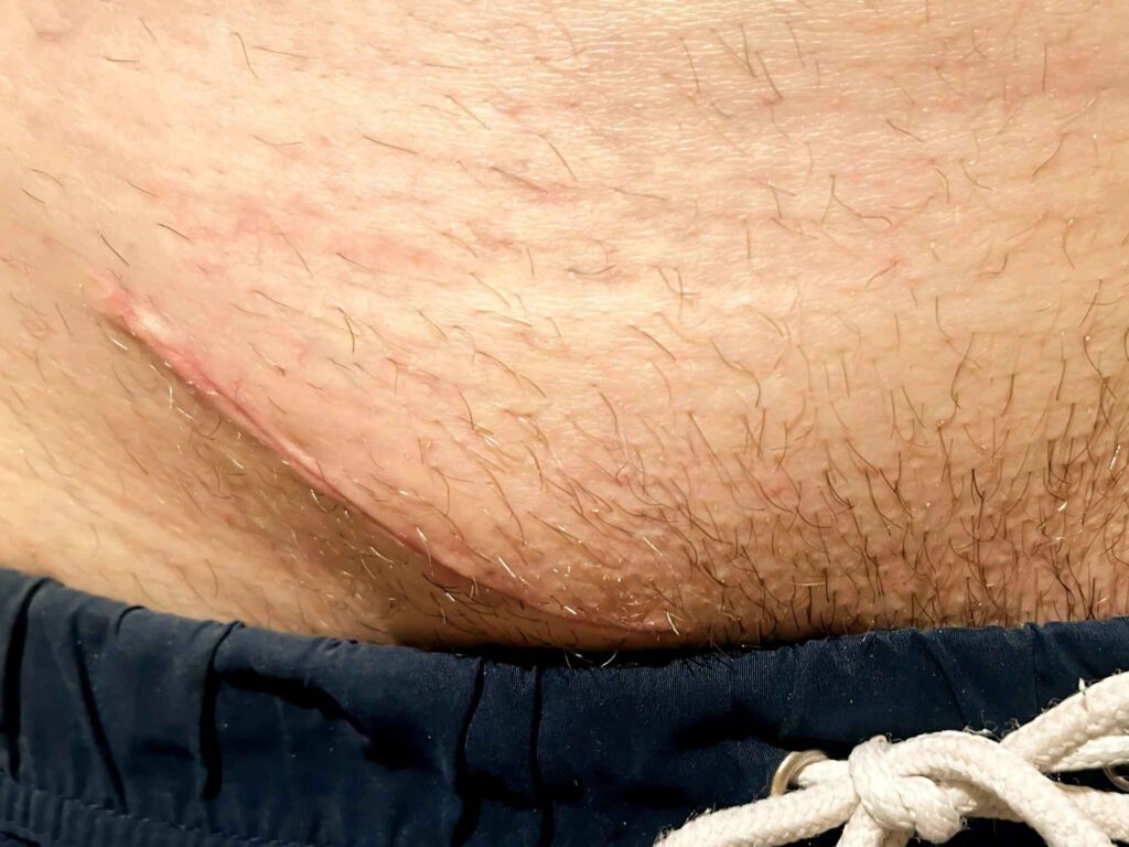 Open Inguinal Exploration